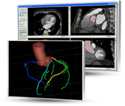 Image: Rcadia COR Analyzer automated analysis of CCTA studies (Photo courtesy of Rcadia Medical Imaging).